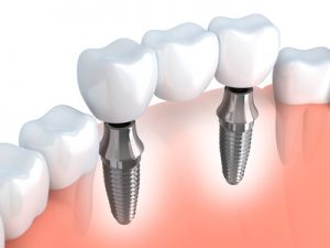 Zahnstaffel - Begrenzung der Leistungen für Zahnersatz in den ersten Jahren